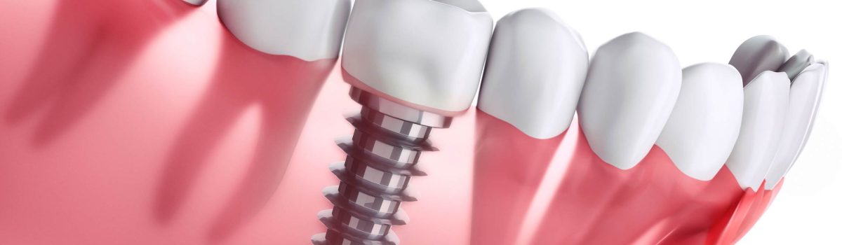 Enhancing Your Smile with the Latest Dental Implant Techniques in Teddington