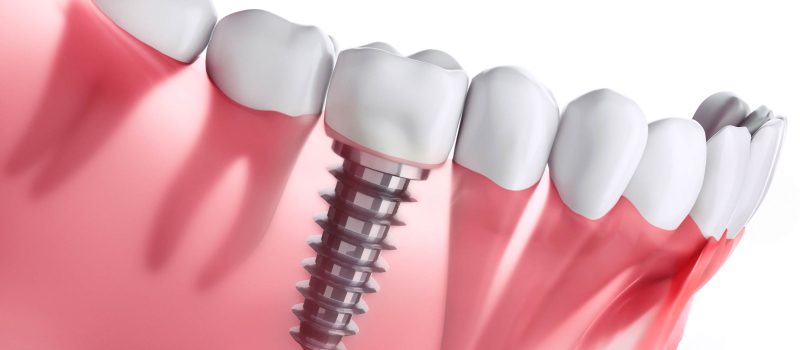 Enhancing Your Smile with the Latest Dental Implant Techniques in Teddington