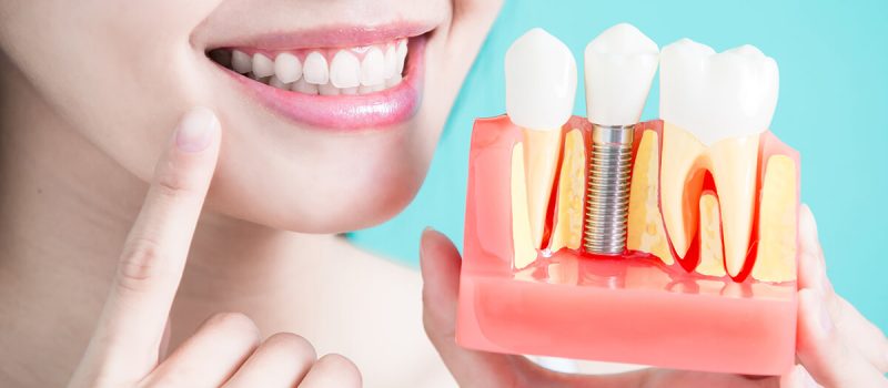 Unlocking New Smiles: Innovative Materials in Dental Implants